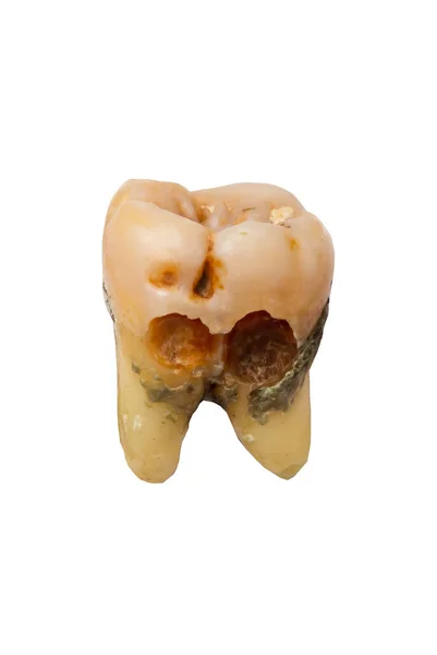 坏牙齿 牙科护理背景 因白人背景而被隔离 — 图库照片