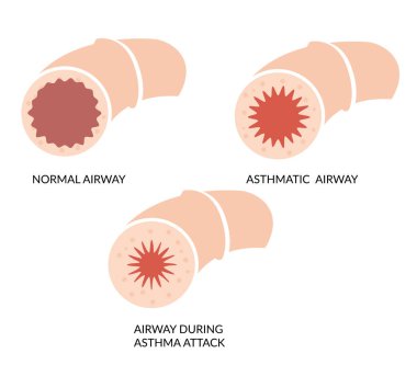 Astım Engellenmiş Hava Yolu - EPS 10 Dosyası Olarak Simge