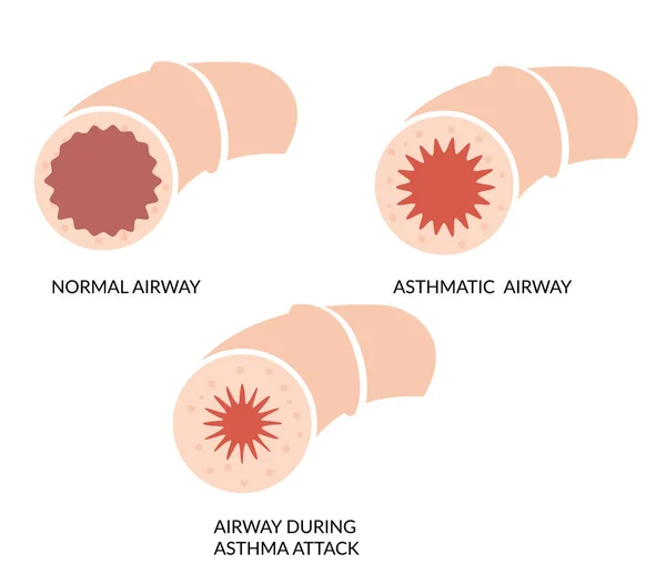 Astma Blockerad Luftväg Ikon Som Eps Fil — Stock vektor