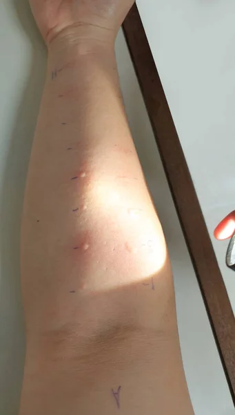 Arm Undersöka Med Allergi Hud Stick Test Utslag Reaktion Med — Stockfoto