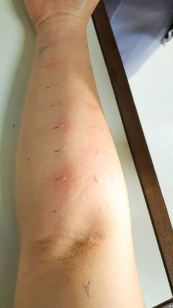 Обследование Руки Аллергией Кожный Укол Сыпь Реакции Аэрозольной Пыли Клеща — стоковое фото
