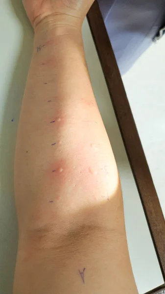 Arm Undersöka Med Allergi Hud Stick Test Utslag Reaktion Med — Stockfoto