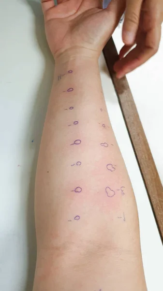 Arm Undersöka Med Allergi Hud Stick Test Utslag Reaktion Med — Stockfoto