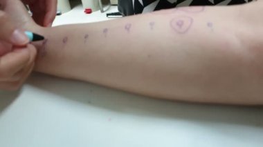 Besin alerjisi testi. Deri iğnesi testi. Kızarıklığa duyarlı tepki.