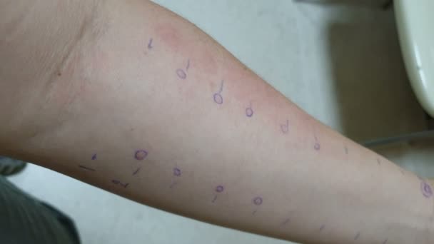 発疹感受性反応を伴う食物アレルギー皮膚ピステストを示す腕 — ストック動画