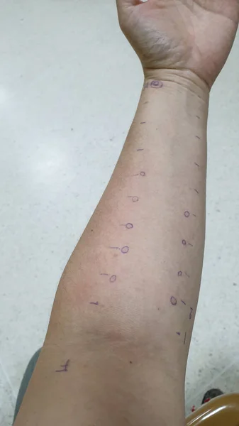 Arm Test Allergi Droppe Undersökning För Känsliga Symptom Röda Utslag — Stockfoto