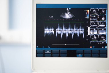 Ultrason ekran görüntü ile kalp kesim, sağ ventrikül çıkım yolu degrade ölçülü.