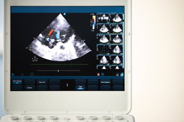 Ultrason ekranda Doppler yöntemi regürjitasyon kapak üzerinde gösteriyor..
