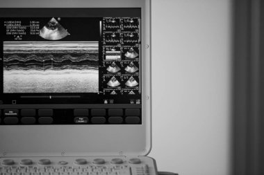 On the screen of the ultrasound apparatus, the scan of the left ventricle of the heart in the position for measuring the ejection fraction by Teyolz. Black and white image. clipart