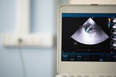 Ultrason cihaz ekranında, bir kalp tarama regürjitasyon Doppler yöntemi kullanarak triküspid kapak üzerinde bir gösteri ile bir dört-odası pozisyonda.