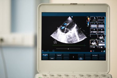 Ultrason ekrandaki görüntü kalbin dört-odası konumu ve Doppler yöntemi olarak trikuspit regürjitasyon gösterir..