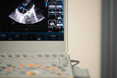 Ultrason ekrandaki görüntü kalbin dört-odası konumu ve Doppler yöntemi olarak trikuspit regürjitasyon gösterir..