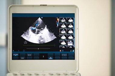 Ultrason ekrandaki görüntü kalbin dört-odası konumu ve Doppler yöntemi olarak trikuspit regürjitasyon gösterir..