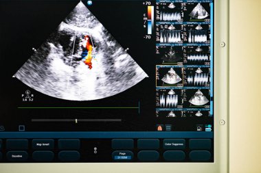 Bir modern Ultrason tarayıcı, kırmızı ve mavi kan kusmak Doppler yöntemi ile tasvir streams kalp boşlukları görüntüyle ekranda.