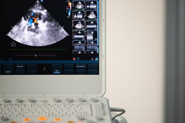 Bir modern Ultrason tarayıcı, kırmızı ve mavi kan kusmak Doppler yöntemi ile tasvir streams kalp boşlukları görüntüyle ekranda.