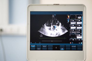 Ultrason tarayıcı, dört-odası pozisyonda kalp görüntüsünü ekranda ve mavi doppler yöntemi ile işaretlenmiş mitral yetersizliği.