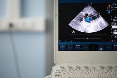 Bir modern Ultrason tarayıcı, kırmızı ve mavi kan kusmak Doppler yöntemi ile tasvir streams kalp boşlukları görüntüyle ekranda.