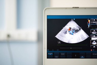 Bir modern Ultrason tarayıcı, kırmızı ve mavi kan kusmak Doppler yöntemi ile tasvir streams kalp boşlukları görüntüyle ekranda.
