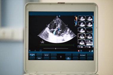 Ultrason tarayıcı ekranında kalp dört-odası bulunduğu görüntü ve mavi ve kırmızı doppler yöntemi tarafından işaretlenir kapak yetersizliğinde tedavi.