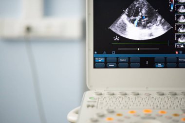 Ultrason tarayıcı ekranında kalp dört-odası bulunduğu görüntü ve mavi ve kırmızı doppler yöntemi tarafından işaretlenir kapak yetersizliğinde tedavi.