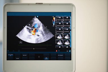 Ultrason tarayıcı ekranında kalp dört-odası bulunduğu görüntü ve mavi ve kırmızı doppler yöntemi tarafından işaretlenir kapak yetersizliğinde tedavi.