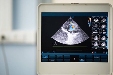 Ultrason tarayıcının sağ ventrikül çıkım yolu ile bir kalp görüntü ekranda Doppler yöntemi ile pulmoner arter çapı ile ölçülen.
