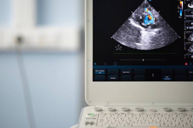 Ultrason tarayıcının sağ ventrikül çıkım yolu ile bir kalp görüntü ekranda Doppler yöntemi ile pulmoner arter çapı ile ölçülen.