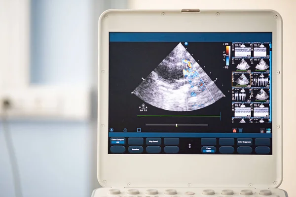 Screen of an ultrasound device with a heart scan. Using the Doppler method, the right ventricular outflow tract is depicted.