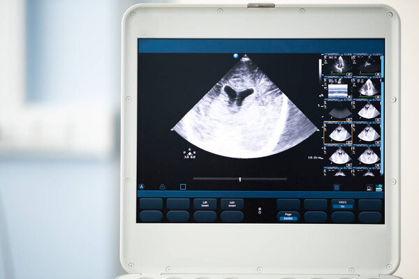 На экране ультразвукового прибора изображено серо-масштабное изображение сканирования мозга, которое проходит через желудочки мозга.
.