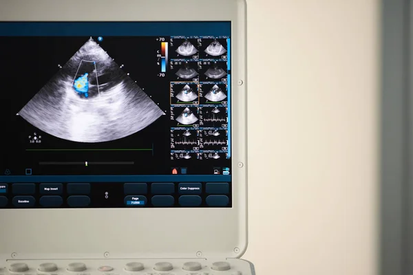 Screen Ultrasound Device Heart Scan Four Chamber Position Doppler Image — Stock Photo, Image