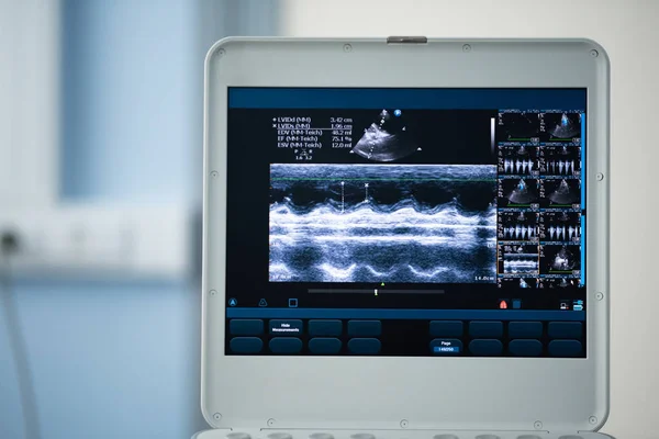 Screen Ultrasound Apparatus Scan Left Ventricle Heart Position Measuring Ejection — Stock Photo, Image