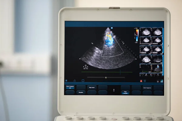 On the screen of the ultrasound device, a heart scan in a four-chamber position with a demonstration of regurgitation on the tricuspid valve using the Doppler method.