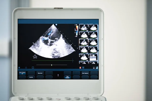Ultrason ekrandaki görüntü kalbin dört-odası konumu ve Doppler yöntemi olarak trikuspit regürjitasyon gösterir..