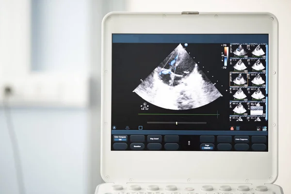 Auf Dem Ultraschallbildschirm Zeigt Das Bild Des Herzens Vier Kammer — Stockfoto