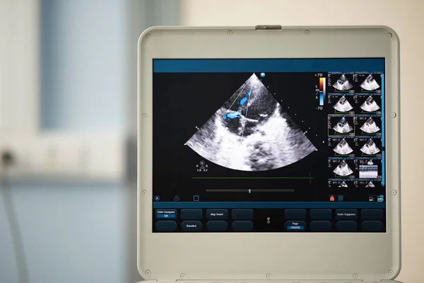 Auf Dem Ultraschallbildschirm Zeigt Das Bild Des Herzens Vier Kammer — Stockfoto