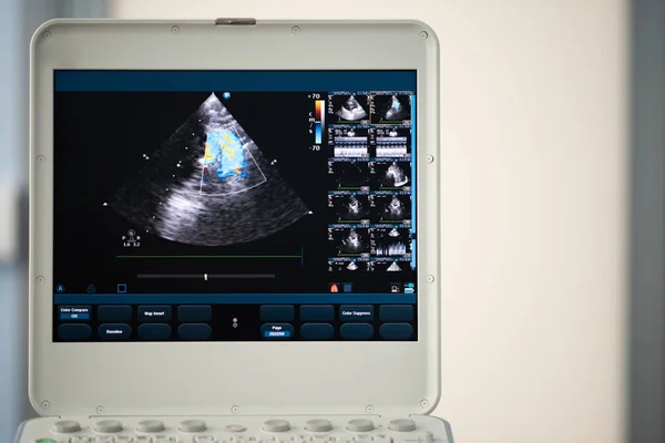 Screen Modern Ultrasound Scanner Image Right Ventricular Outflow Tract Doppler — Stock Photo, Image