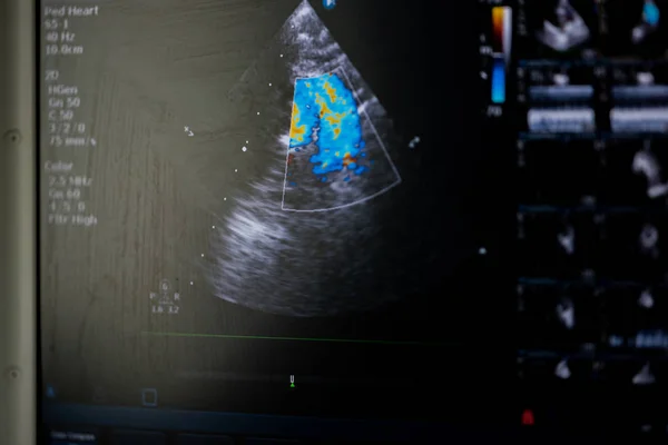 Screen Modern Ultrasound Scanner Image Right Ventricular Outflow Tract Doppler — Stock Photo, Image