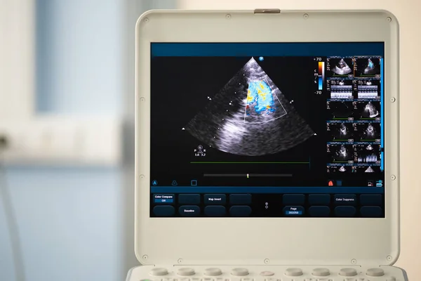 Obrazovce Moderní Ultrazvuk Skeneru Obraz Bronchopneumonie Výtokové Dopplerovské Mapování — Stock fotografie