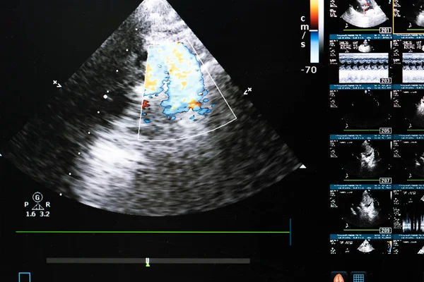 Obrazovce Moderního Ultrazvukového Skeneru Obraz Bronchopneumonie Výtokové Dopplerovské Mapování Modrém — Stock fotografie