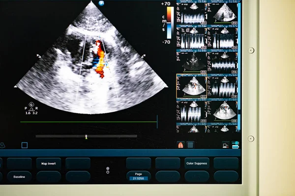 モダンな超音波スキャナー 超音波ドプラ法で描かれている血液逆流の赤と青のストリームと心の空洞の画像の画面で — ストック写真