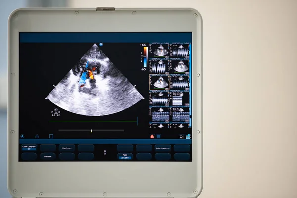 Obrazovce Moderního Ultrazvukového Skeneru Obraz Dutin Srdce Červenou Modrou Proudy — Stock fotografie