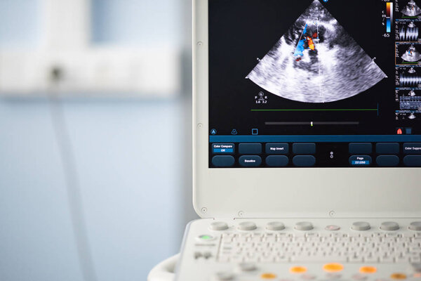 На экране современного ультразвукового сканера изображение полостей сердца с красными и голубыми потоками кровоизлияния, изображенное методом Доплера
.