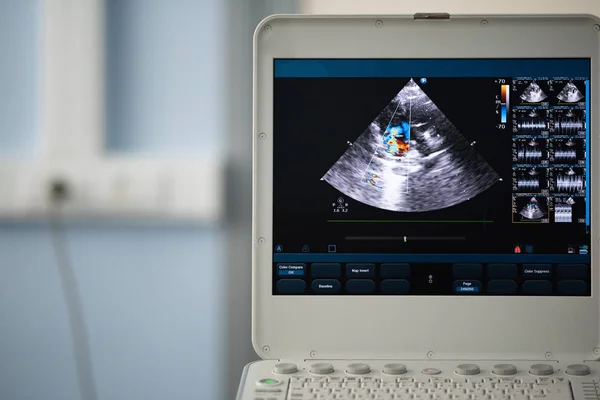 Auf Dem Bildschirm Eines Modernen Ultraschallscanners Ein Bild Der Herzhöhlen — Stockfoto