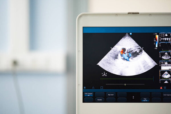 На экране современного ультразвукового сканера изображение полостей сердца с красными и голубыми потоками кровоизлияния, изображенное методом Доплера
.