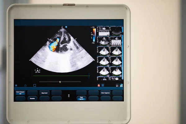 Obrazovce Ultrazvukového Skeneru Srdce Obraz Pozici Čtyřkomorová Označené Doppler Metodou — Stock fotografie