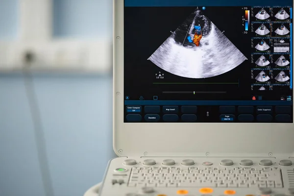 Auf Dem Bildschirm Des Ultraschallscanners Das Herzbild Der Vier Kammer — Stockfoto