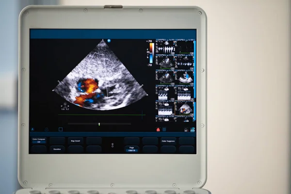 Auf Dem Bildschirm Eines Modernen Ultraschallscanners Einem Herzbild Mit Einem — Stockfoto