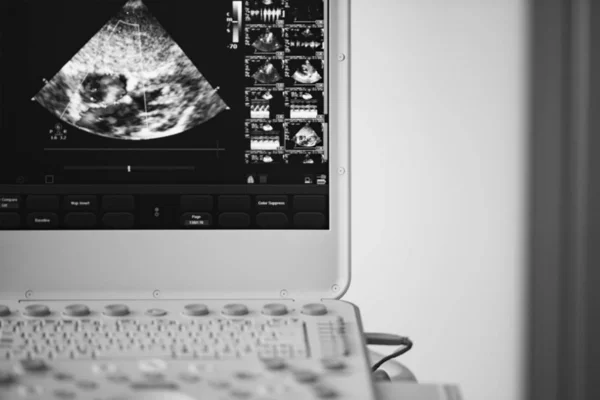 Obrazovce Moderní Ultrazvukový Skener Obraz Srdce Interatrial Vadou Označené Doppler — Stock fotografie