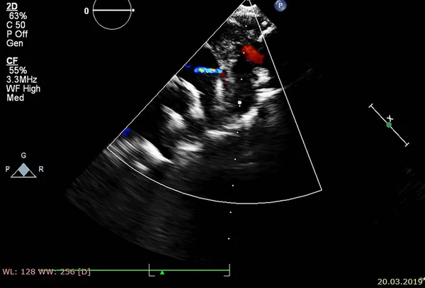 Obrazovka počítače s echokardiografií (ultrazvukem). — Stock fotografie