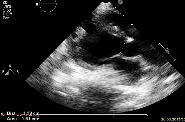 Tela da máquina de ecocardiografia (ultra-som) . — Fotografia de Stock